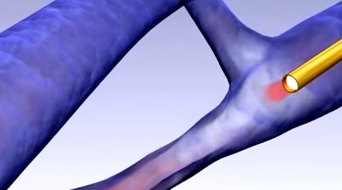 Lazer ile damar içi varis tedavisi animasyon